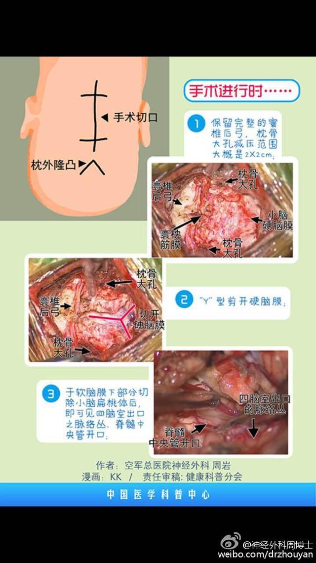 漫画科普 &ldquo;麻小&rdquo;的罪证 脊髓空洞症