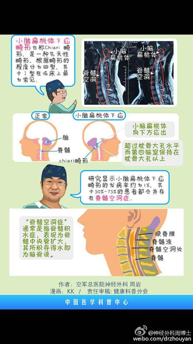 漫画科普 &ldquo;麻小&rdquo;的罪证 脊髓空洞症