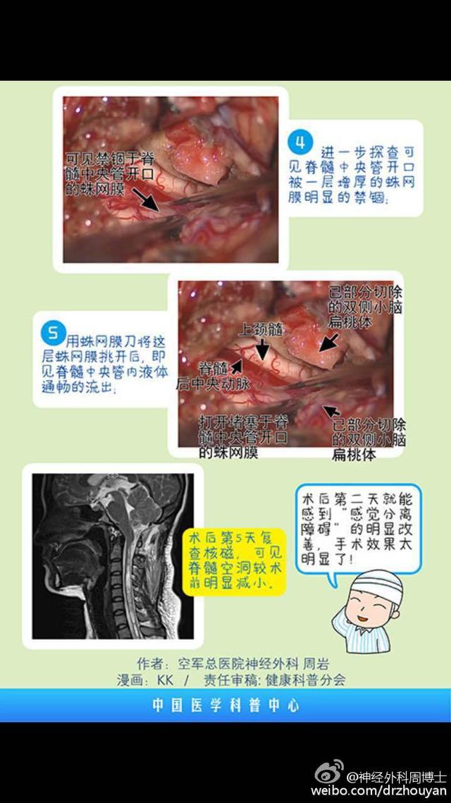 漫画科普 &ldquo;麻小&rdquo;的罪证 脊髓空洞症