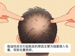 脂溢性皮炎引起脱发的原因