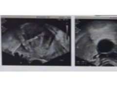 子宫腺肌症术后措施要做好，甲硝唑赶走致病细菌