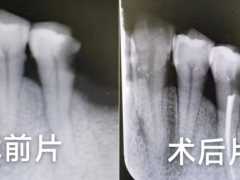 牙齿疼痛难忍，当心牙髓炎在作祟