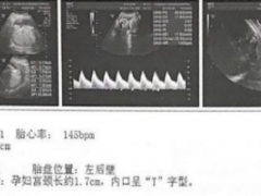 出现阴道流血不可忽视，有可能是先兆早产哦