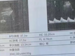 孕晚期前置胎盘，竟与人工流产有关