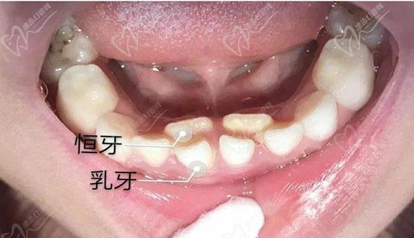 双排牙