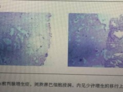 82岁高龄尿潴留怎么办，看我“大显神通”