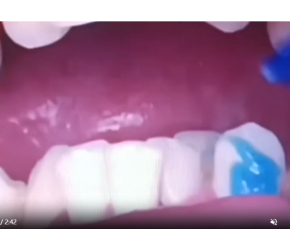 牙齿矫正视频