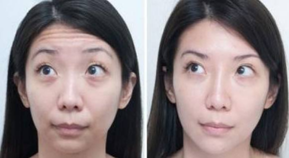 除皱瘦脸祛抬头纹
