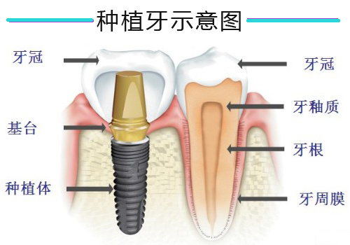 即刻种植牙什么时候安装临时牙