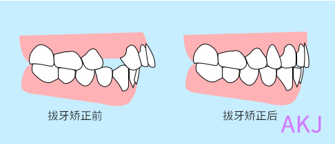龅牙