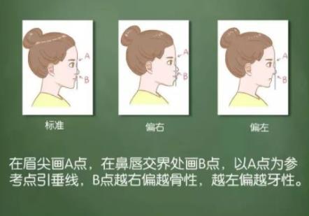 龅牙如何判断骨性还是牙性