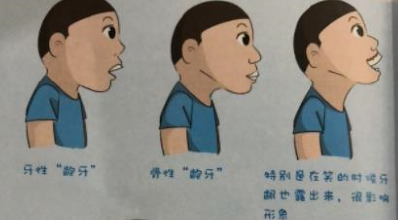 龅牙