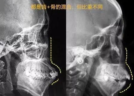 骨性龅牙与牙性龅牙