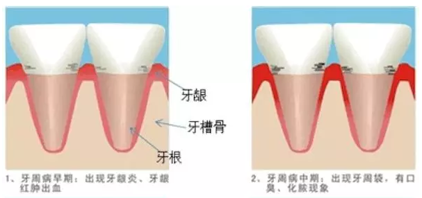龅牙矫正价格