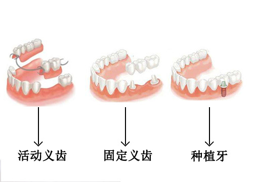牙齿缺失三种假牙