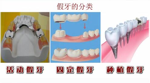 三种假牙
