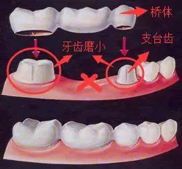 烤瓷牙