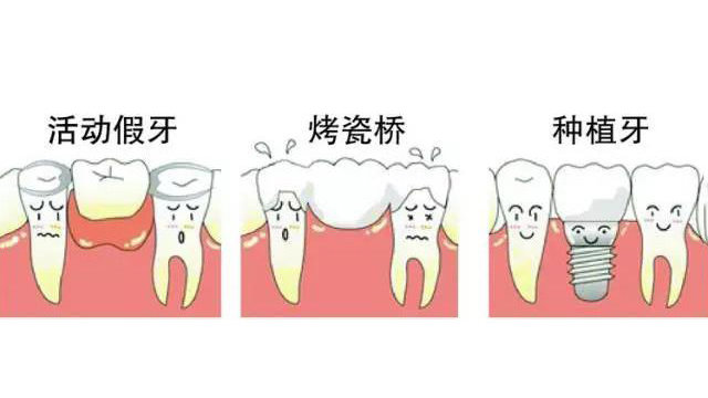 镶牙三种方式