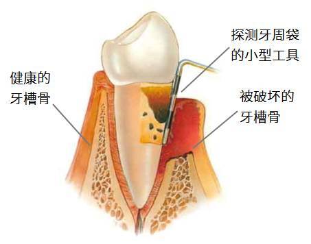 牙槽骨被破坏