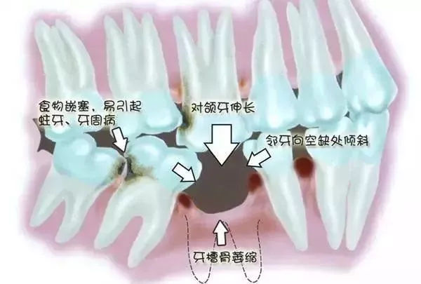 牙齿缺损、缺失及时镶牙的原因