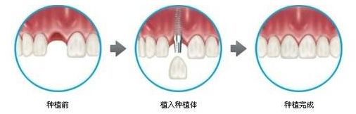 种植牙的缺点