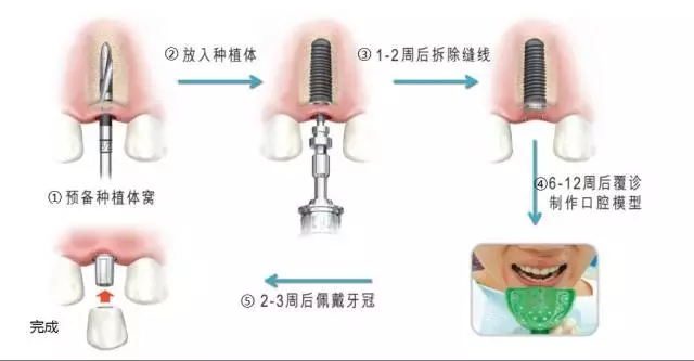 种植牙齿需要多少钱