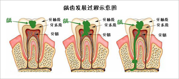 蛀牙发展过程