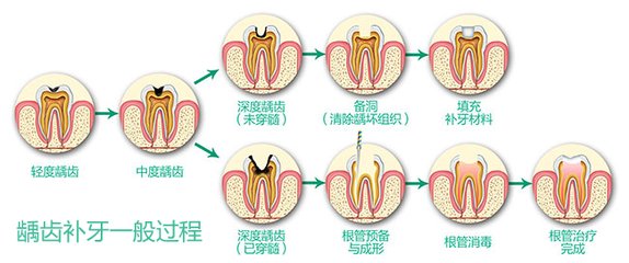 儿童补牙要杀神经吗