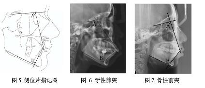 龅牙牙性还是骨性