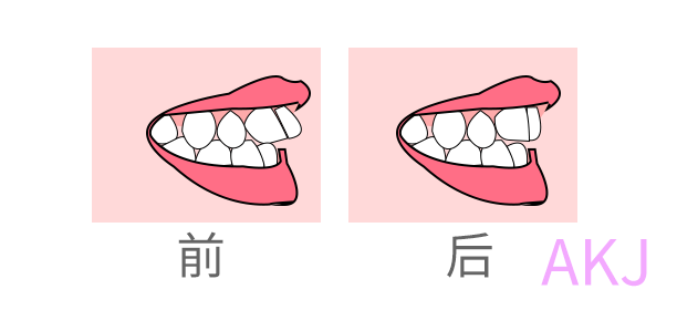 牙齿矫正