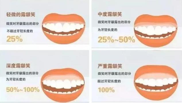 露龈笑