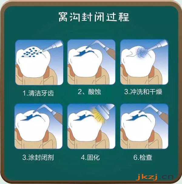 窝沟封闭的过程
