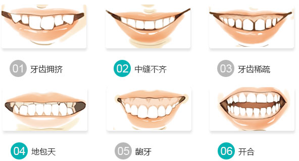 牙齿畸形需要做牙齿矫正