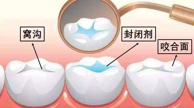 窝沟、咬合面和封闭剂