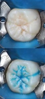 窝沟封闭