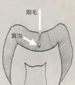 牙齿的窝沟位置