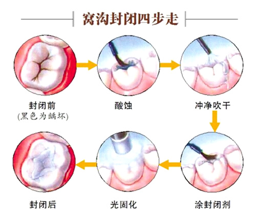 窝沟封闭的年龄