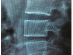 急性腰扭伤可急不得，腰痛宁胶囊赶走腰痛