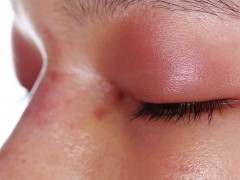 透明质酸隆鼻的危害如何避免