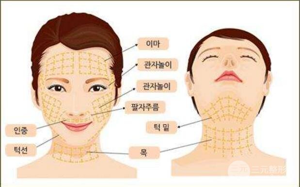 韩国面部除皱手术火到爆,带你了解一下这个抗衰手术~