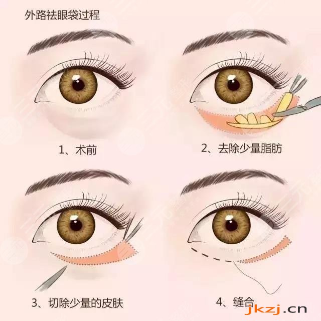 去眼袋手术会反弹吗
