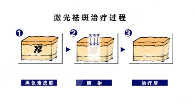 激光祛斑的价格是多少?