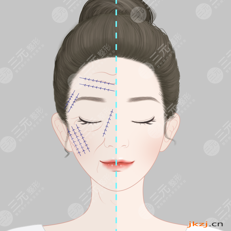 徐威强磨骨案例