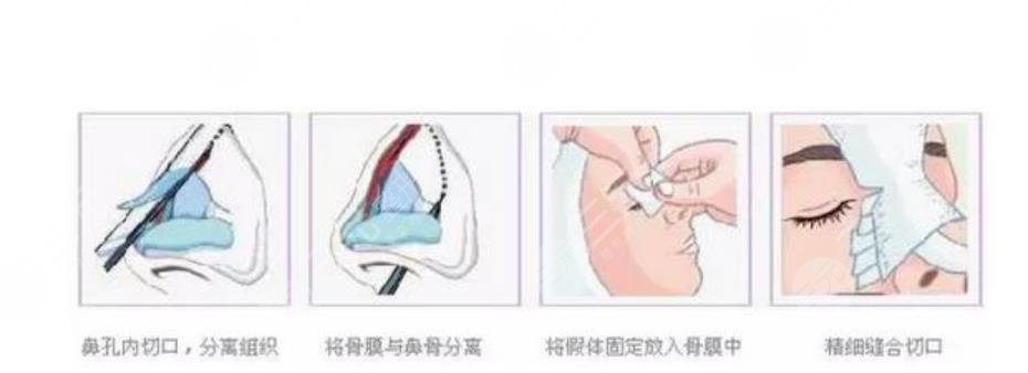 隆鼻