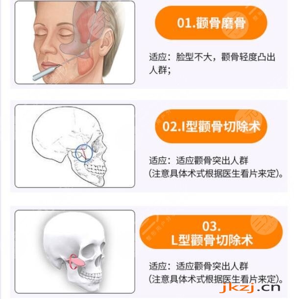 磨颧骨手术没问题吗?