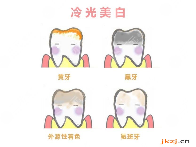 苏州佳成口腔医院牙齿美白相关介绍