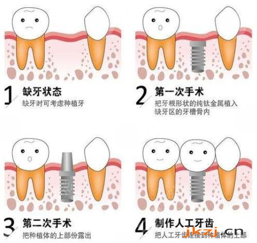 种植牙技术治疗的过程