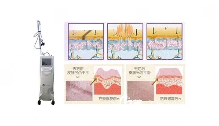 疤痕形成原因