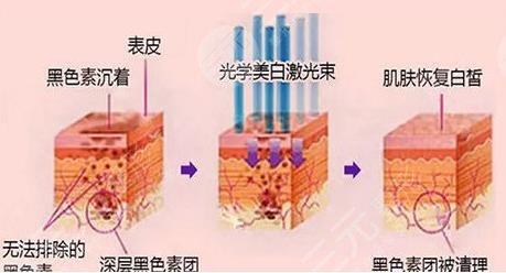 光子嫩肤相关知识科普 :光子嫩肤是什么呢?