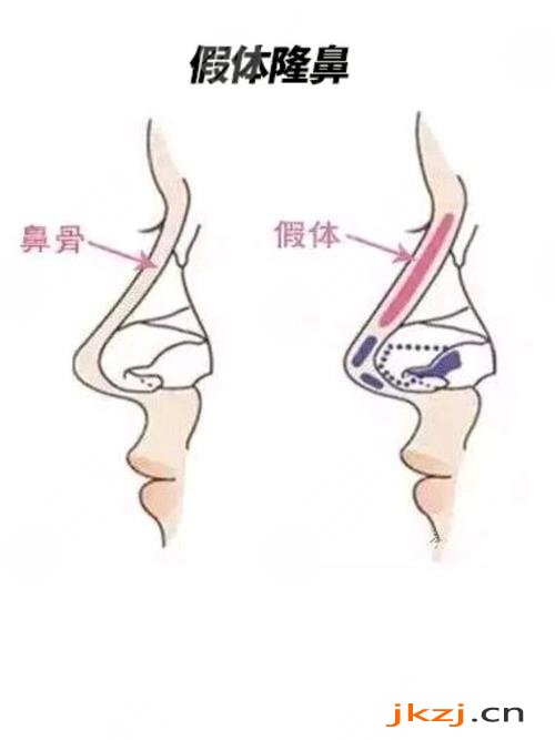 硅胶假体+半肋隆鼻前有什么注意事项?